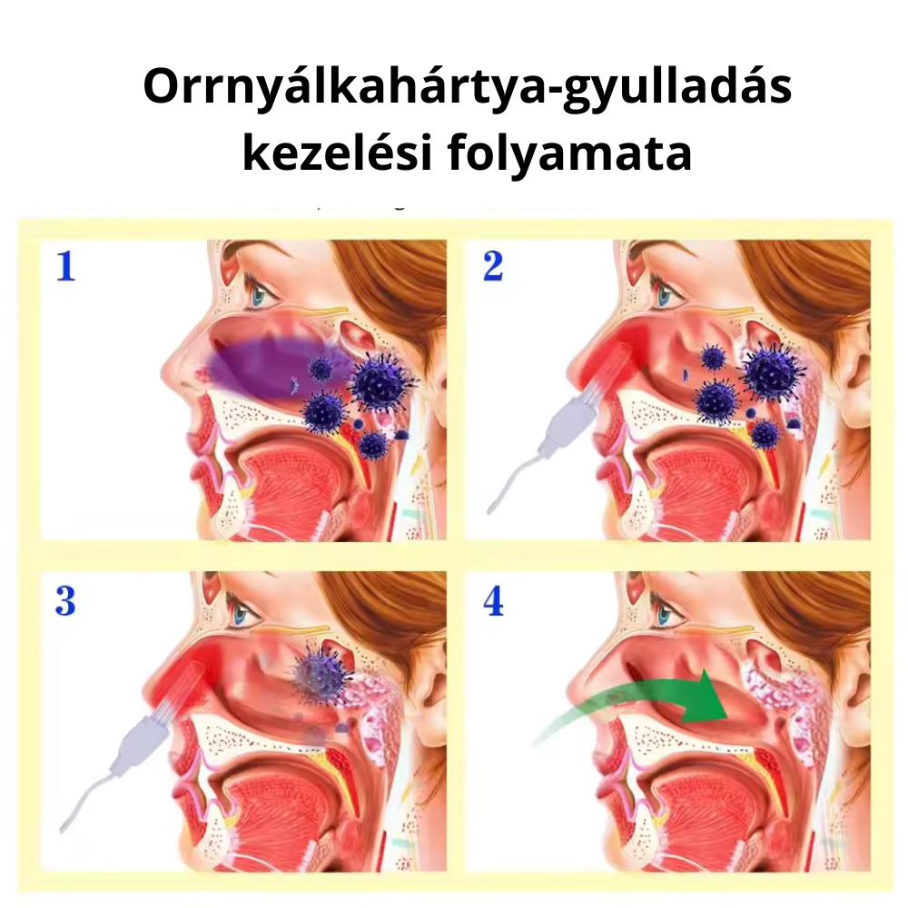 Fényterápiás készülék orrdugulás, nátha, allergia kezelésére